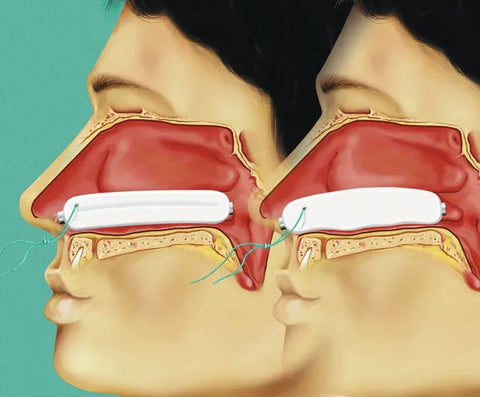 Raucocel Stirnband 175x40mm Lohmann & Rauscher