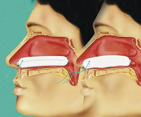 Raucocel Nasentamponade gerade, steril mit Faden Lohmann & Rauscher